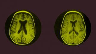 Impacto de la desnutrición en la masa cerebral.