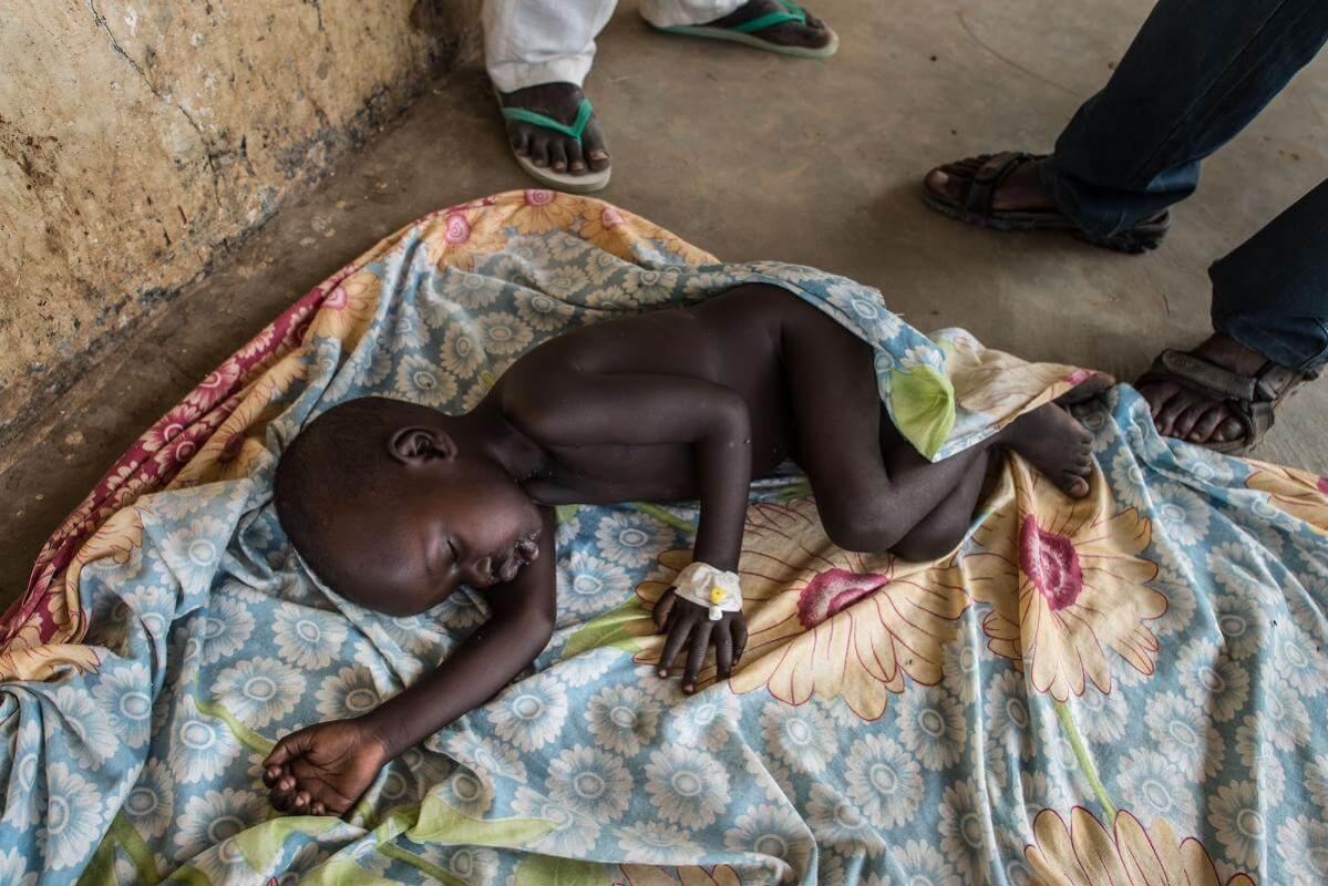 Este niño padece desnutrición y fue admitido en la OTP (Programa terapéutico para pacientes ambulatorios) de Malualbai, en Sudán del Sur.